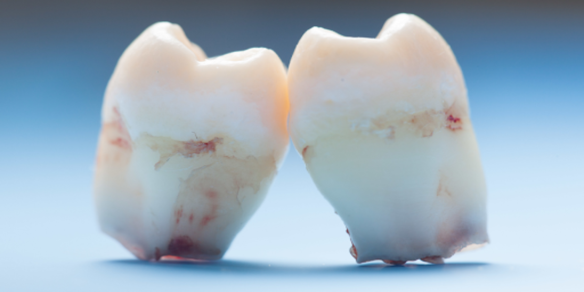 More Babies Are Now Born Without Wisdom Teeth, Study Finds