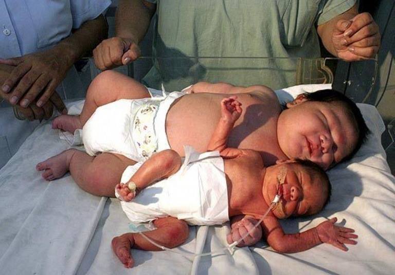 The biggest baby in history weighs 18 kilos and was born in Australia