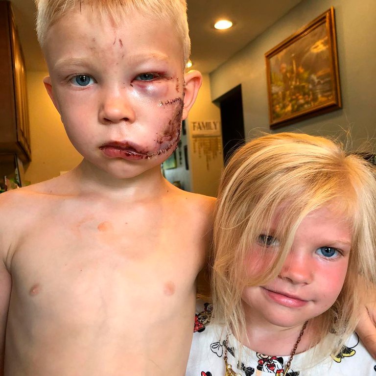 Bridger Walker, a superhero who saved his 6-year-old sister after a dog attack