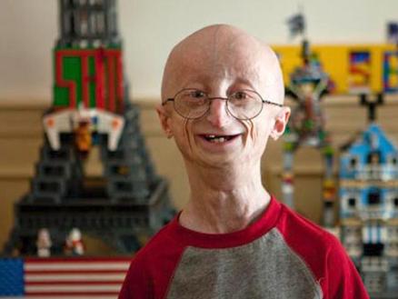 Hutchinson-Gilford progeria syndrome