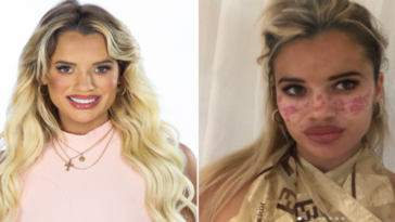 Influencer lost vision and was left with scars after trying out a TikTok 'trick'