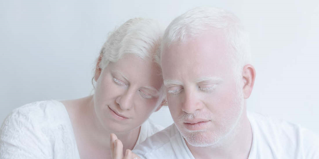 Albinism is a heterogeneous genetic disorder, caused by mutations in different genes, which results in a reduction or total absence of melanin pigment in the eyes, skin and hair.