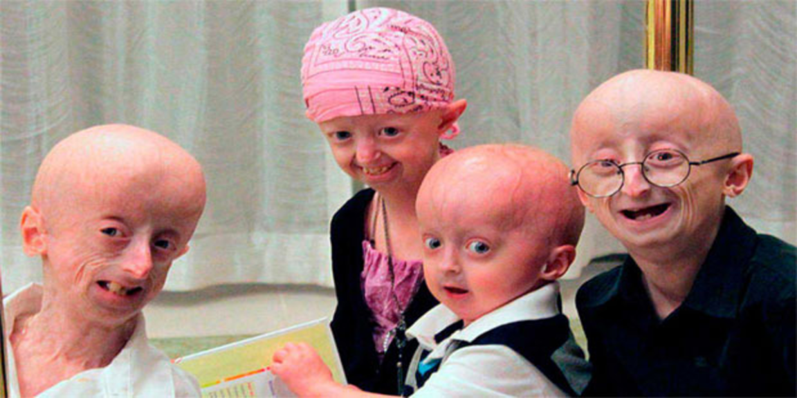 Hutchinson-Gilford progeria syndrome