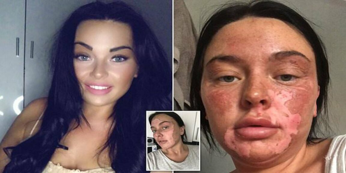 Woman suffers burns after her attempt to poach eggs goes wrong