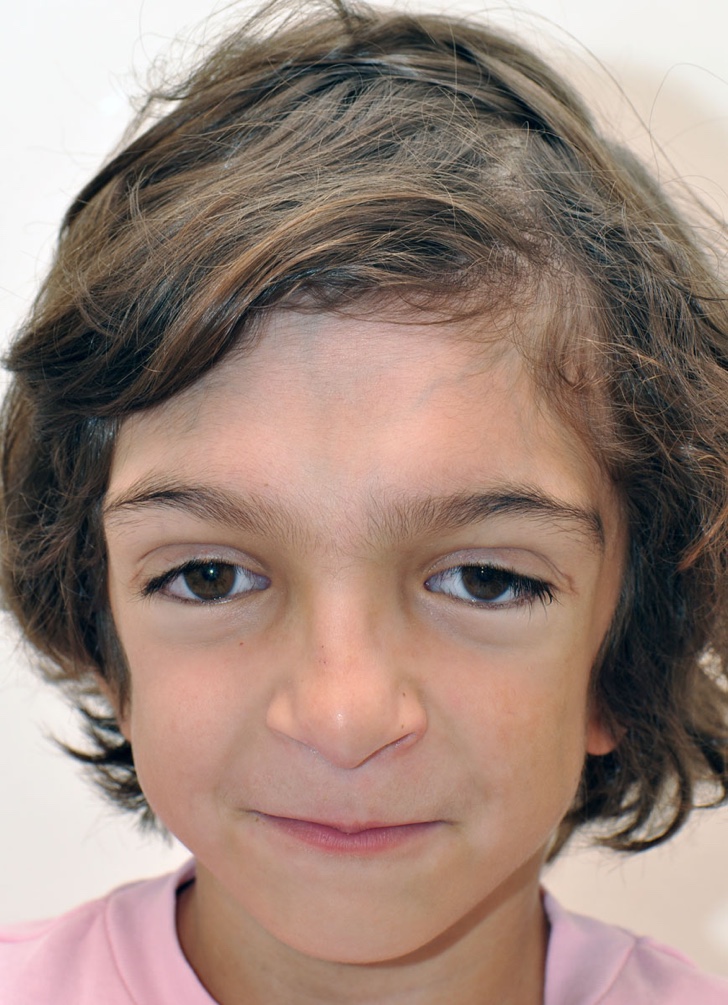 A rare syndrome disfigured his face at birth. After treatment, we see the beginning of his smile
