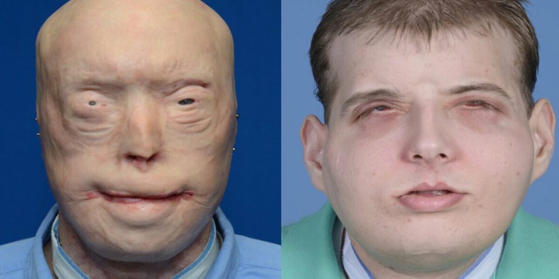 Man who underwent world's most extensive face transplant operation reveals how it has changed his life
