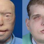 Man who underwent world's most extensive face transplant operation reveals how it has changed his life