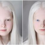 Albinism and heterochromia conjugated in the same person cause unusual beauty