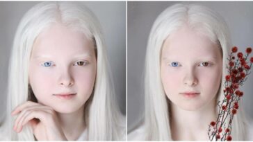Albinism and heterochromia conjugated in the same person cause unusual beauty