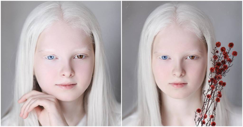 Albinism and heterochromia conjugated in the same person cause unusual beauty