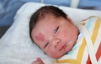 The baby has a heart-shaped birthmark on his face: here are the cute pictures