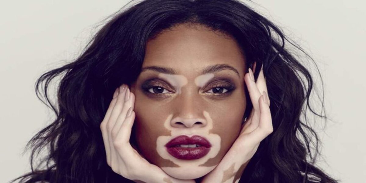 Vitiligo is a skin disease that causes the formation of white spots