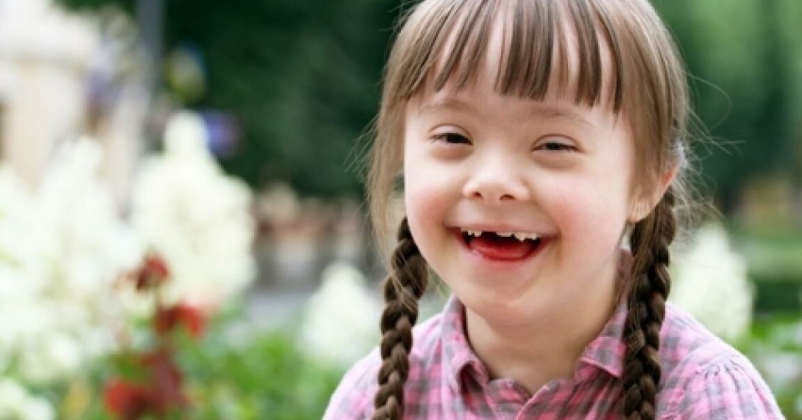 Down syndrome: what it is, causes, diagnosis and more