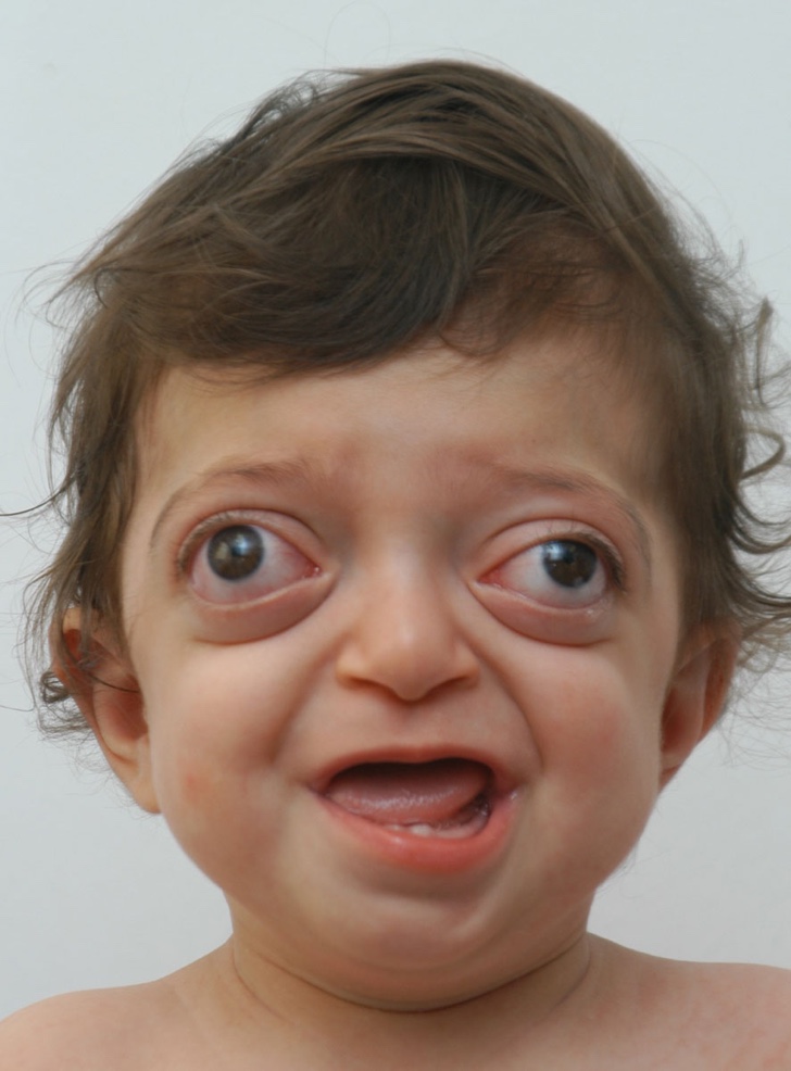 A rare syndrome disfigured his face at birth. After treatment, we see the beginning of his smile