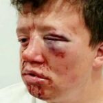 Disabled soccer fan suffers terrifying facial injuries in 'brutal attack'