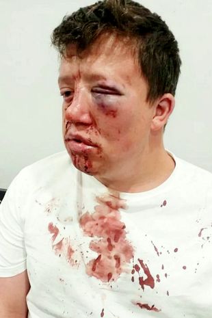 Disabled soccer fan suffers terrifying facial injuries in 'brutal attack'