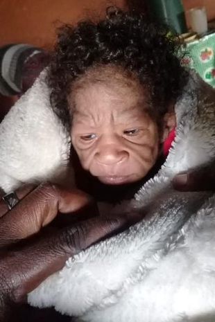 Mom gives birth to daughter who 'looks older than she is' due to rare medical condition