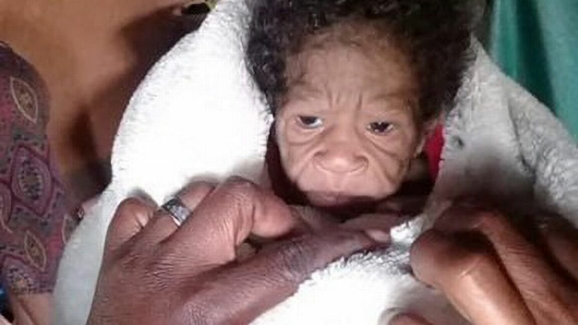 Mom gives birth to daughter who 'looks older than she is' due to rare medical condition