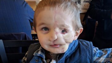 Boy has face ripped off after dog attack: other kids call him a monster