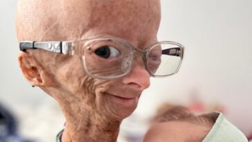 YouTuber with rare Benjamin Button aging disease died at age 15