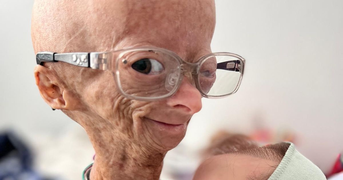 YouTuber with rare Benjamin Button aging disease died at age 15